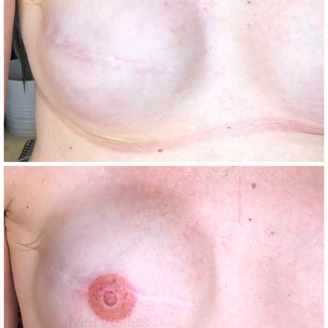 Merveilles_tattoo Aréoles mammaires 3D